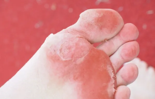 Cómo se usa el ácido bórico en los pies